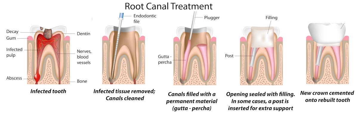 What Happens During A Root Canal Appointment Root Of Endodontics