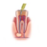 root canal, endodontics, tooth pain, tooth infection, root canal symptoms, cracked tooth, root canal retreatment, Root of Endodontics, root canal therapy, Arvada CO, Dr. Emmanuel Paguio