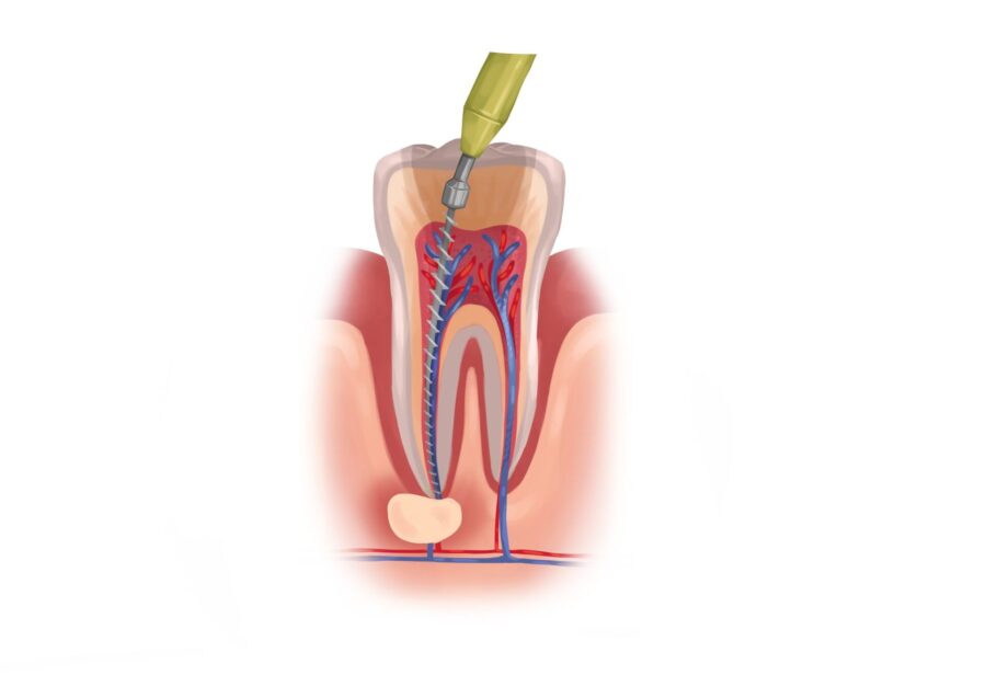 root canal, endodontics, tooth pain, tooth infection, root canal symptoms, cracked tooth, root canal retreatment, Root of Endodontics, root canal therapy, Arvada CO, Dr. Emmanuel Paguio