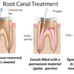 graphic showing what happens in root canal appointment, root canal procedure, endodontic care, Root of Endodontics, Arvada CO, tooth pain relief, saving natural teeth, gentle root canal, Dr. Emmanuel Paguio