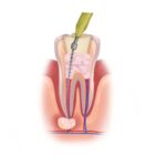 root canal retreatment